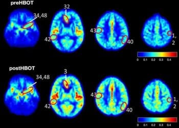 Scientific Studies in Hyperbaric Medicine